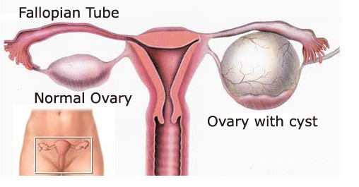 Cyst Ovarian